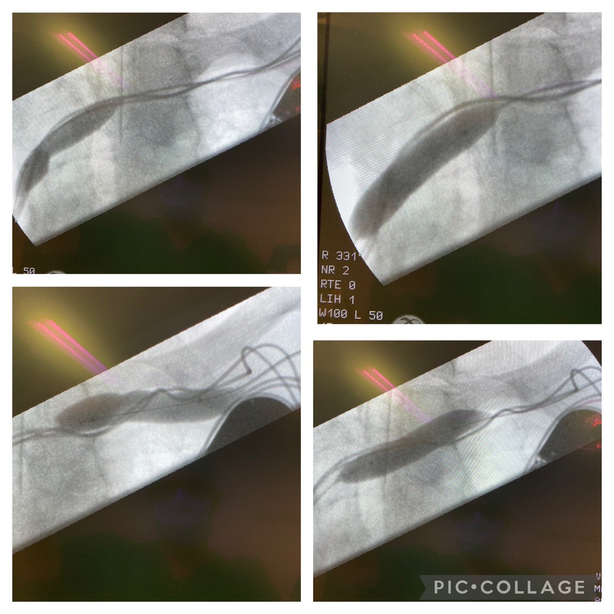 robshahverdyan's tweet photo. Patient referred 1 week after an externally created #BCAVF when a 3 years old #RCAVF failed, discharged with postoperative massive arm swelling and cannulation difficulties due to ipsilateral pacemaker. #TCVO and cephalic arch stenosis treated with 8mm #Conquest40 HPB &amp; 12mm POBA https://t.co/EdLHuKPJRb
