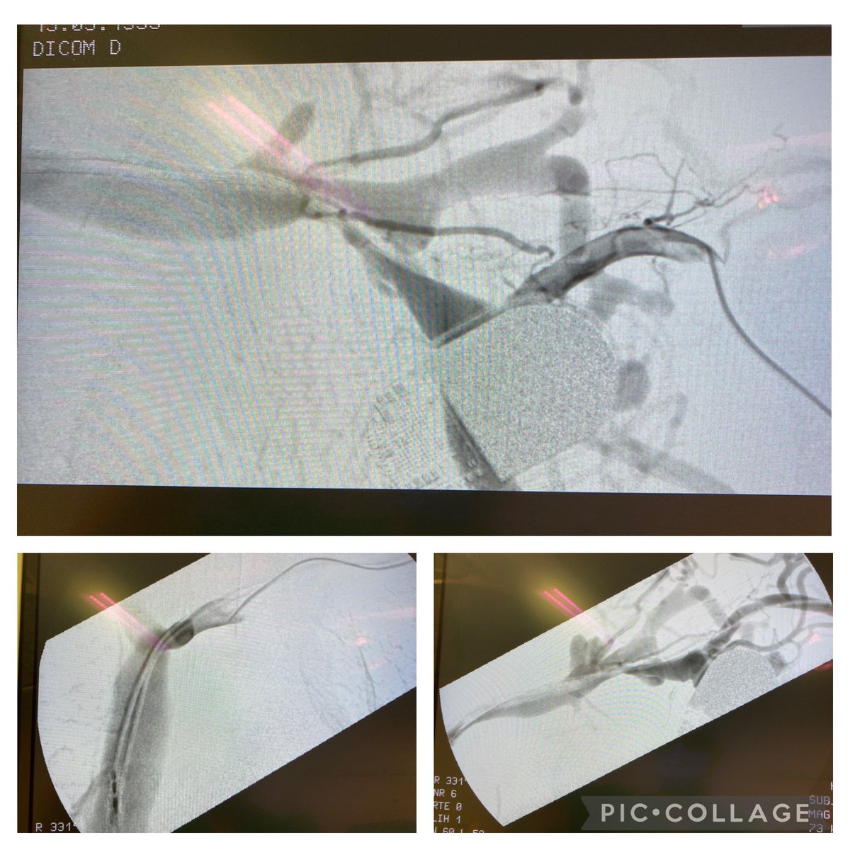 robshahverdyan's tweet photo. Patient referred 1 week after an externally created #BCAVF when a 3 years old #RCAVF failed, discharged with postoperative massive arm swelling and cannulation difficulties due to ipsilateral pacemaker. #TCVO and cephalic arch stenosis treated with 8mm #Conquest40 HPB &amp; 12mm POBA https://t.co/EdLHuKPJRb