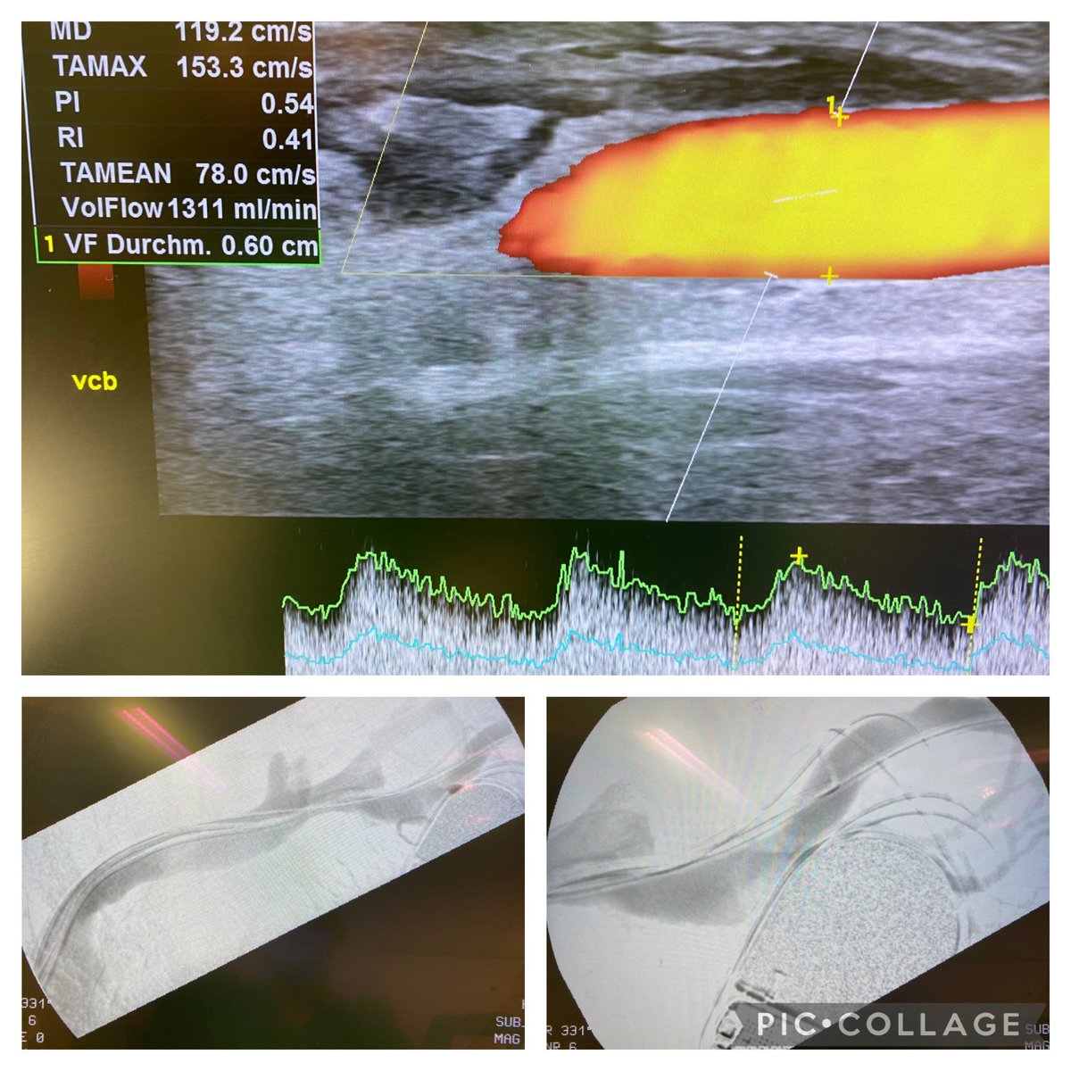 robshahverdyan's tweet photo. Patient referred 1 week after an externally created #BCAVF when a 3 years old #RCAVF failed, discharged with postoperative massive arm swelling and cannulation difficulties due to ipsilateral pacemaker. #TCVO and cephalic arch stenosis treated with 8mm #Conquest40 HPB &amp; 12mm POBA https://t.co/EdLHuKPJRb