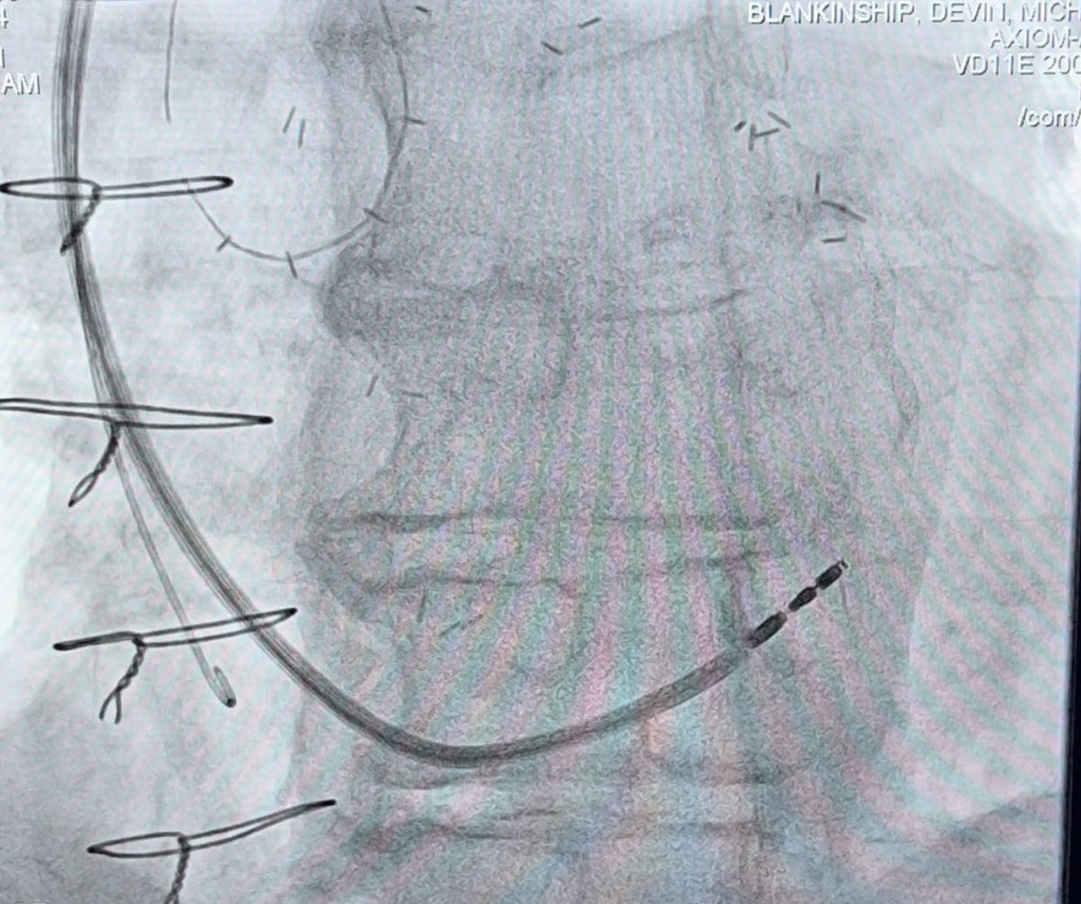 Great success so far with the new Biotronik sheath for conduction system pacing! <a href="/MUSC_EP/">MUSC Electrophysiology</a> <a href="/JRWinterfield/">Jeffrey Winterfield</a> <a href="/MUSCCardFellows/">MUSC Cardiology Fellowship Programs</a> #EPeeps