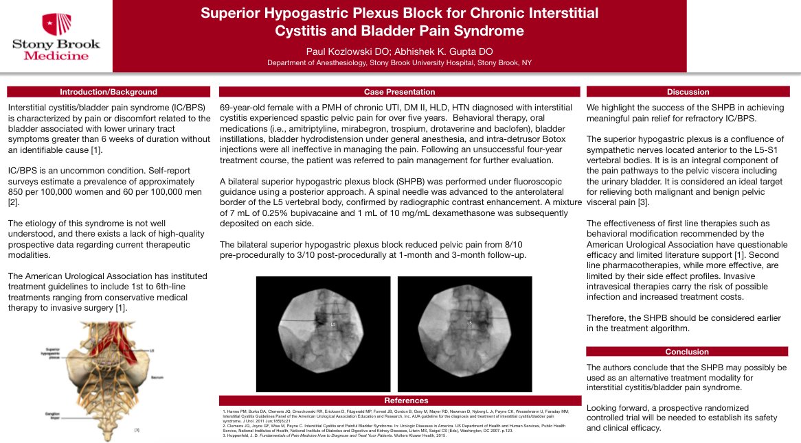 ASPN_PainNeuro's tweet photo. "The superior hypogastric plexus is a confluence of sympathetic nerves located anterior to the L5-S1 vertebral bodies. It is considered an ideal target for relieving both malignant and benign pelvic visceral pain"#ASPNAbstracts #MedEd #MedTwitter @stonybrooku #29 https://t.co/hThYhEehKx