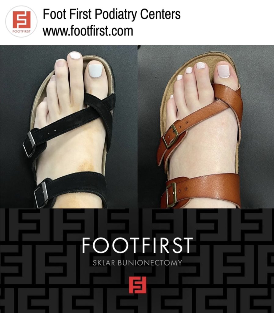footfirstpod's tweet photo. It’s awesome when patients bring back #sandals to follow up visits. This patient is 6 months post Sklar #Bunionectomy®️&amp; #toeshortening.  She did not have a cast or have to use crutches &amp; was able to get back into a gym shoe in 3 weeks. For more info go to https://t.co/CGpW8xELcu https://t.co/QUuqexs8MO