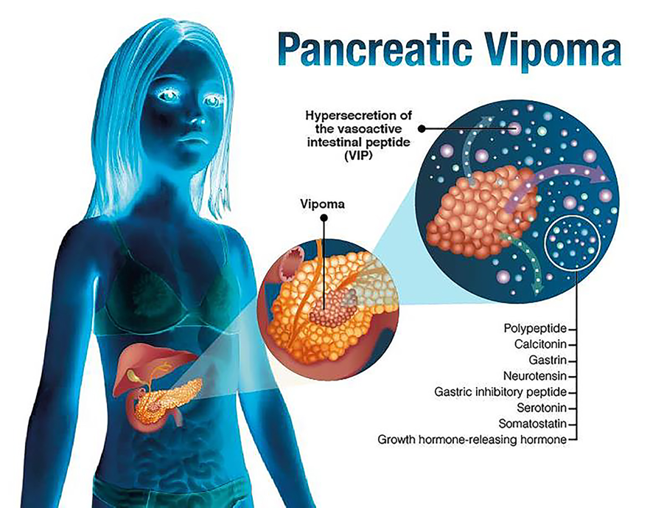 American Association of Endocrine Surgeons (@theaaes) on Twitter photo VIPoma is a rare PNET that produces vasoactive intestinal peptide (VIP) which causes watery diarrhea, low potassium, and low chloride. Also known as Verner-Morrison syndrome.
#NETAM2021 #NeuroendocrineTumor #LetsTalkAboutNETs
<a href="/NANETS1/">NANETS</a> <a href="/CarcinoidNETs/">CarcinoidCancer CCF</a> @LACNETS <a href="/PheoPara/">Pheo Para Alliance</a> VIPoma is a rare PNET that produces vasoactive intestinal peptide (VIP) which causes watery diarrhea, low potassium, and low chloride. Also known as Verner-Morrison syndrome.
#NETAM2021 #NeuroendocrineTumor #LetsTalkAboutNETs
<a href="/NANETS1/">NANETS</a> <a href="/CarcinoidNETs/">CarcinoidCancer CCF</a> @LACNETS <a href="/PheoPara/">Pheo Para Alliance</a>