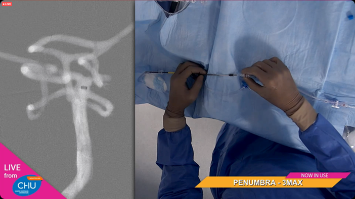 PenumbraEMEA's tweet photo. EMEA HCPs: @AmeerEHassan &amp; Dr. Lefevre conducting a flow model posterior stroke case at @slice_worldwide. Challenging PCA P1 occlusion and impressive FPE TICI 3 result! #JET7 #3MAX
Rx only. For risk info: https://t.co/EUzIbhQyWE Clinical results may vary https://t.co/cruJsjzSnm