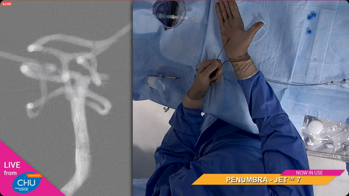 PenumbraEMEA's tweet photo. EMEA HCPs: @AmeerEHassan &amp; Dr. Lefevre conducting a flow model posterior stroke case at @slice_worldwide. Challenging PCA P1 occlusion and impressive FPE TICI 3 result! #JET7 #3MAX
Rx only. For risk info: https://t.co/EUzIbhQyWE Clinical results may vary https://t.co/cruJsjzSnm
