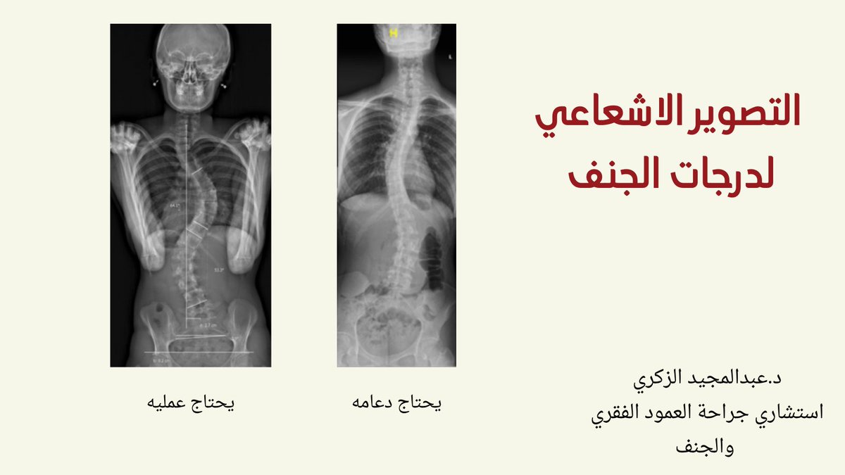 AlzakriA's tweet photo. #الجنف #الظهر #صحتك #صحتك_حياتك التصوير الإشعاعي لدرجات الجنف يوضح مقدار الانحناء للعمود الفقري https://t.co/O6NAmjO2ee