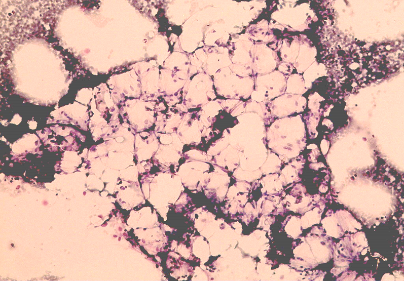 TheEBMT_Trainee's tweet photo. Welcome to our first @TheEBMT_Trainee Twitter Case!
6-yr old boy w/ weakness and nosebleed for 2 weeks. Diffuse petechial rash and pale skin. No significant family or past medical history. He has not taken any medications. Hgb 8.2 (Retic 17) Plt 20 Leuk 0.75 (ANC 0.4). BM biopsy: https://t.co/NrECBss3Yy