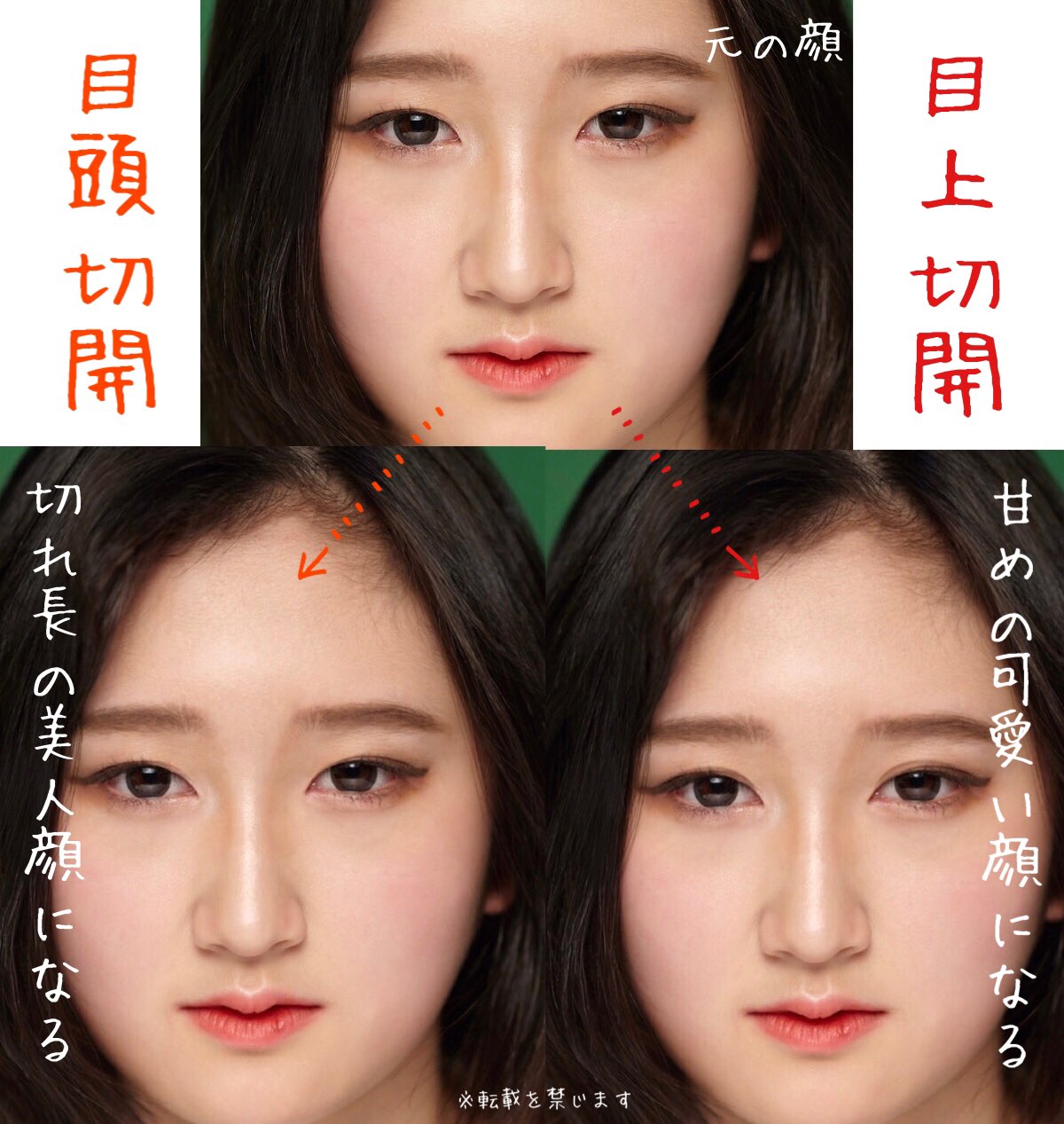 二重整形の病院選び 目頭切開 眉下切開 埋没法 グラマラスライン 全切開 眼瞼下垂 目尻切開の失敗 目頭切開 で目指したい目と目上切開で目指したい目は違う 目上切開は目が丸っこくなりやすく 目頭切開はアーモンドアイっぽくなりやすい 深田