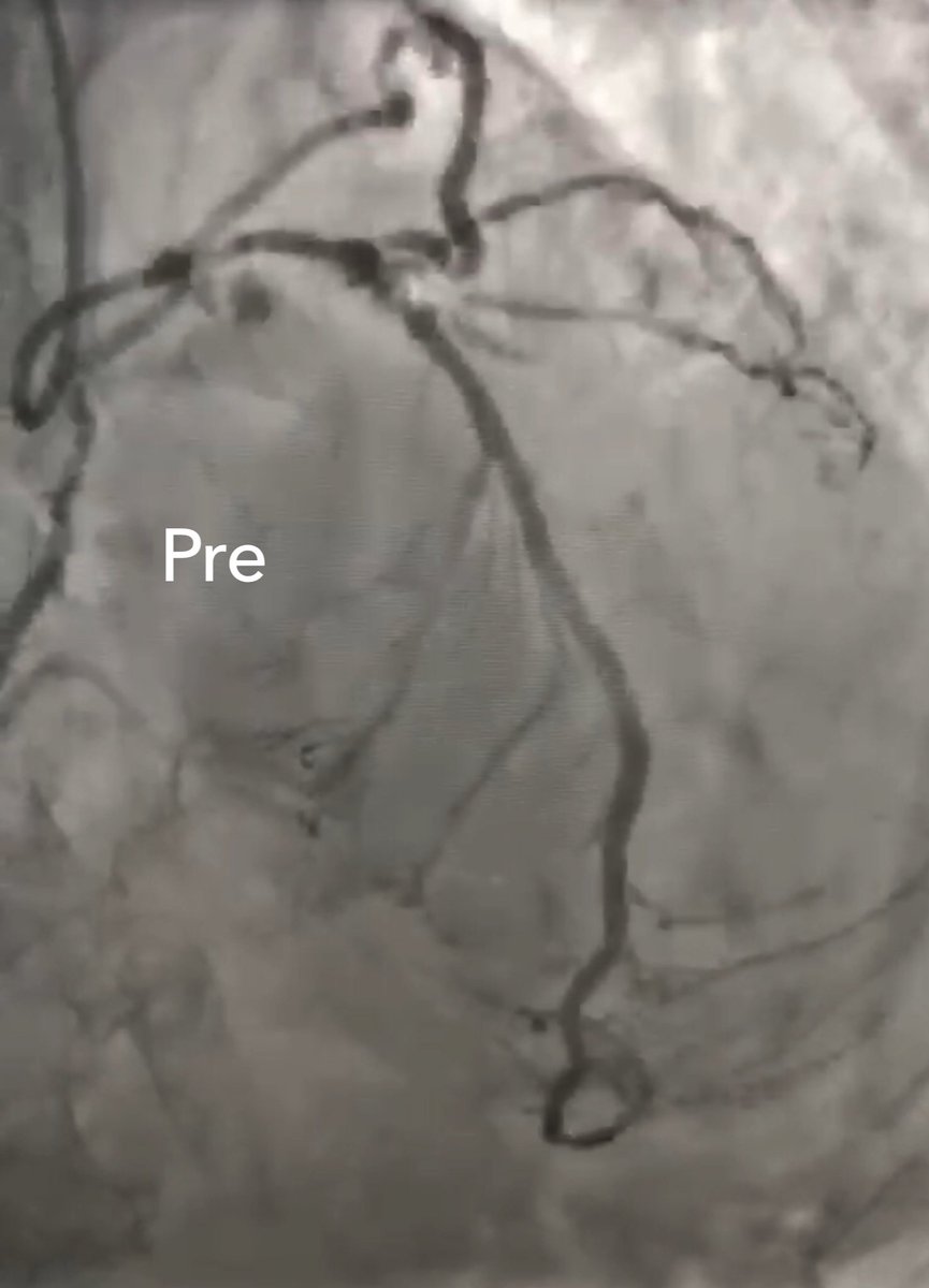 mirvatalasnag's tweet photo. #CulpritShock put to the test
#Minimalism
85M sailed thru it w MCS, single stent & GDMT (note improved HR)
#ACCIC #EAPCI @PCRonline @APSIC6 https://t.co/J1BPtMe6XG