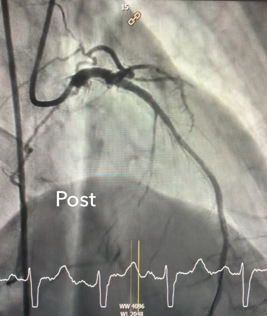 mirvatalasnag's tweet photo. #CulpritShock put to the test
#Minimalism
85M sailed thru it w MCS, single stent & GDMT (note improved HR)
#ACCIC #EAPCI @PCRonline @APSIC6 https://t.co/J1BPtMe6XG