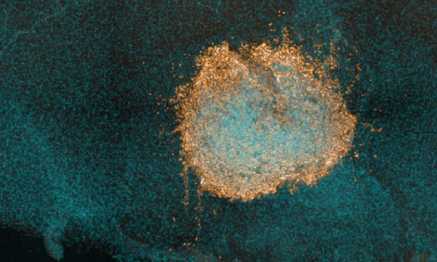 RMresearch_'s tweet photo. 📰.@ICR_London scientists have discovered that combining the drugs trametinib &amp; dasatinib could be a potential new #CancerTreatment for some children with the incurable #BrainCancer, #DIPG, who have evolved resistance to treatment

Read the full story at: https://t.co/jWygB8aqfc https://t.co/zHbGfeCSrp