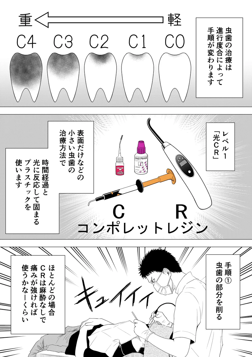 歯医者さんの治療の手順！何をしているのか分かりやすい！