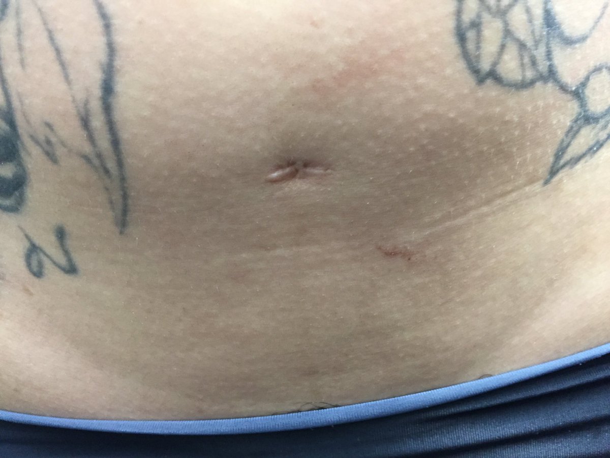 VENOM88356048's tweet image. #刺青　#secrettattoo #stickertattoo #coveruptattoo
#tattoogirls #ステッカータトゥー　#カバーアップタトゥー　#タトゥーガールズ　#高槻市