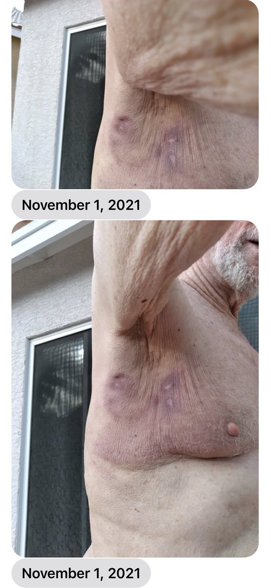 Bye bye Cancer.   Saved another one in less than 2 months this client took <a href="/ScalerAide/">ScalerAide</a>  every (2) waking hours held under tongue 👅 also nebulizing (misting) daily as well applied soaked cotton balls in Scaler Silver Solution weekly.  💯 SAFE &amp; NATURAL ONLY (2) ingredients;.