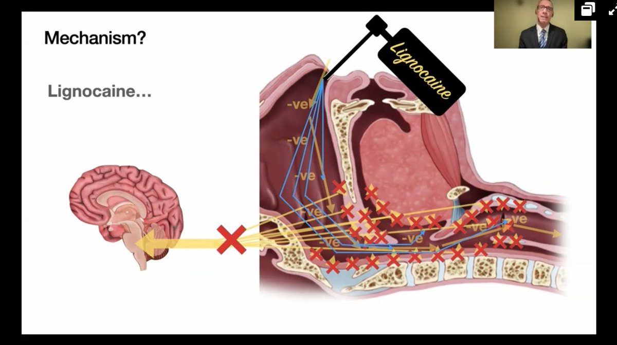 David Vaughan (@oldandbaffled) on Twitter photo @jadamlaw fascinating keynote on dangers of awake topicalisation. Lidocaine blocks the reflex arc causing pharyngeal dilator activation in response to negative pressure in the pharynx during inspiration
<a href="/dasairway/">Difficult Airway Society (DAS)</a> @dastrainees @DAS_2021 #vDAS2021 @jadamlaw fascinating keynote on dangers of awake topicalisation. Lidocaine blocks the reflex arc causing pharyngeal dilator activation in response to negative pressure in the pharynx during inspiration
<a href="/dasairway/">Difficult Airway Society (DAS)</a> @dastrainees @DAS_2021 #vDAS2021