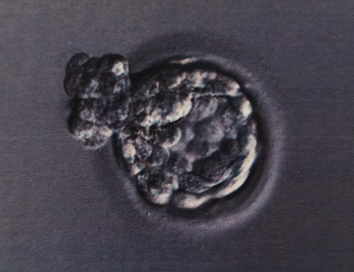 #infertilpandy aquí mi frozen transferido 04/11 😍 un blasto d día 5 AA eclosionando + DGP. Hemos arreglado el útero de mama y llevamos la medicación inmunológica que nos han mandado. Por favor, quédate 🙏🙏 Empieza oficialmente la #betaespera 🤞🤞🍀🍀🍀😵🎉🌈🤯😰😱😱❄️