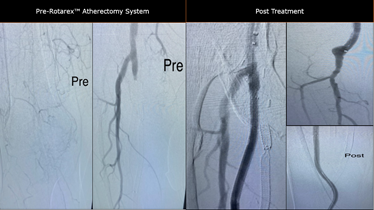 BDandCo_PI's tweet photo. Cleaned the graft! Awesome!” – Dr. Oak using Rotarex™ Atherectomy Device in a thrombosed fempop graft
#RemoveWithRotarex #Rotarex
Not for use in the cardiopulmonary, coronary, carotid, cerebral, renal or venous vasculature. Safety info: https://t.co/xPcDQTcv4A https://t.co/HVG3VpWOs3