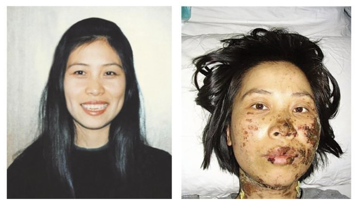 Asiatique6's tweet photo. "Avant sa mort, Gao a été détenue au camp de travail de Shenyang Longshan, où elle a été soumise à sept heures de chocs électriques sur le visage. Une photo du visage défiguré de Gao a choqué le monde entier." https://t.co/XXE2ruhOFn https://t.co/OjUvXqZDYs