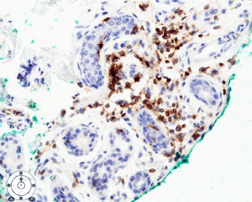 Young male with abrupt anhidrosis, -Painful sensations when hot
-Hx of cholinergic urticaria
Biopsy (anhidrotic area)
Perieccrine CD3+ lymphocytes&amp;
normal eccrine coils
Idiopathic Pure Sudomotor failure!
-May have elevated IgE
-Tx with systemic steroids
#dermpath #pathtwitter
