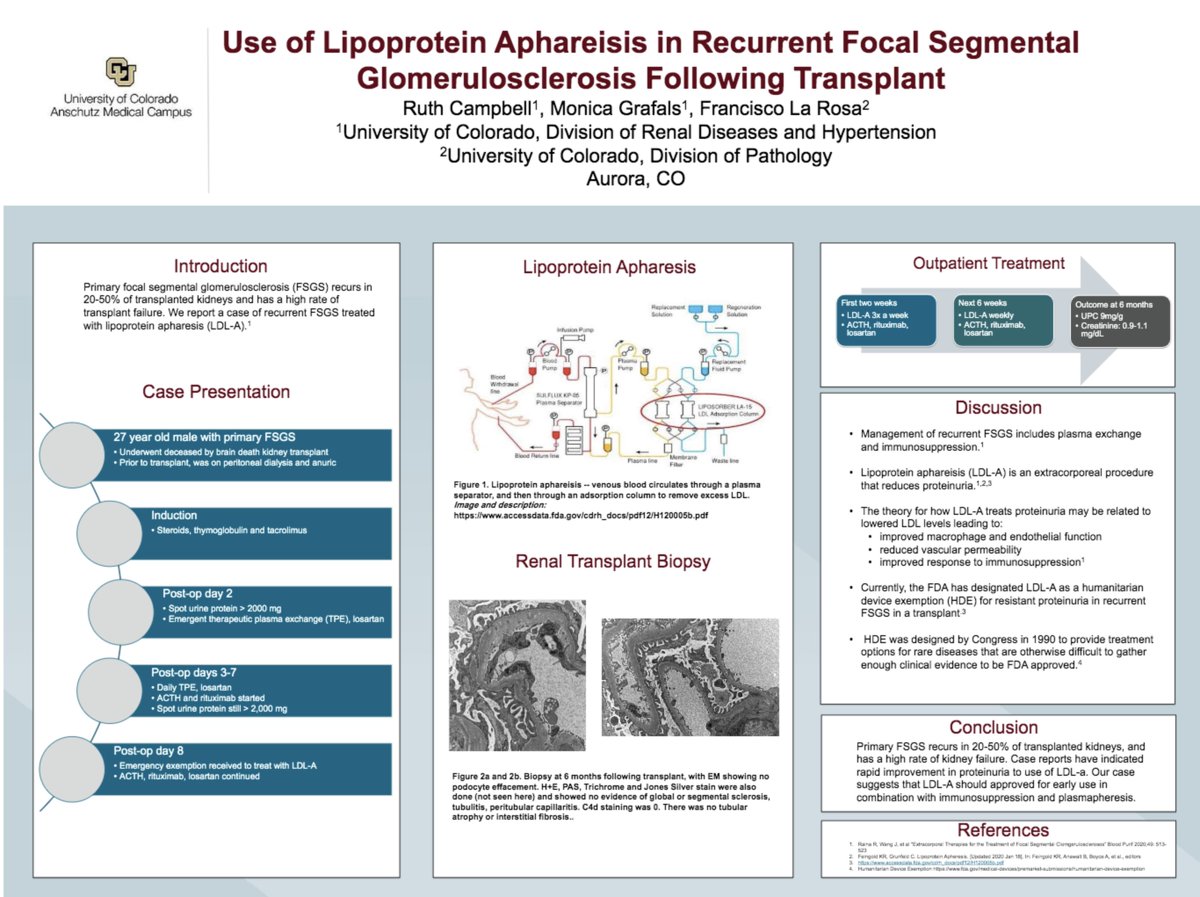 Use of Lipoprotein Aphareisis in Recurrent Focal Segmental Glomerulosclerosis Following Transplant
<a href="/ruth_e_campbell/">Ruth Campbell</a> #KidneyWk

asn.apprisor.org/epsAbstractASN…