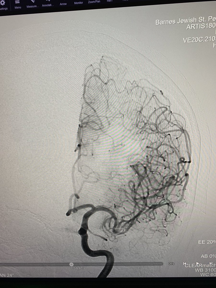 Excited to perform this first thrombectomy at <a href="/BJCStCharlesCo/">Barnes-Jewish St. Peters and Progress West</a>. In case you’re wondering, TICI2c reperfusion, and the team acted like they’ve been taking calls for months.