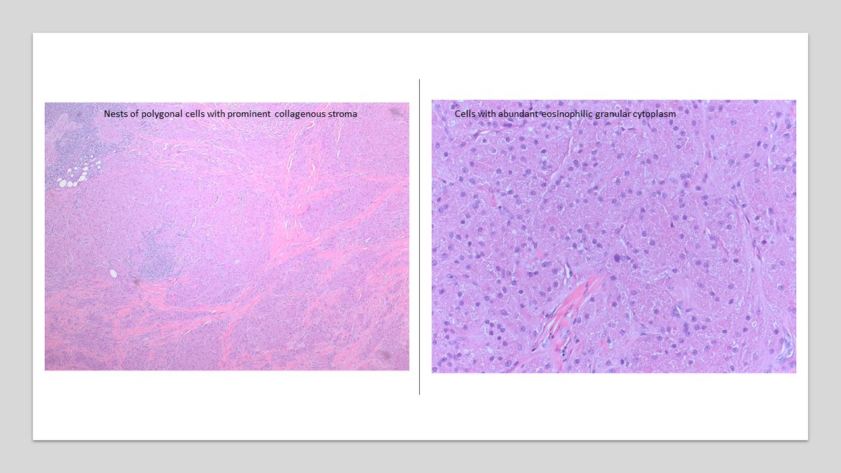 Middle aged African American female with oral cavity mass- Granular cell tumor-S100 (diffuse strong +), SOX10 (+),  PAS(+), diastase-resistant cytoplasmic granules. GrCT shows ≥ 3 atypical features (pleomorphism, prominent nucleoli, increased mitoses#dermpath #surgpath