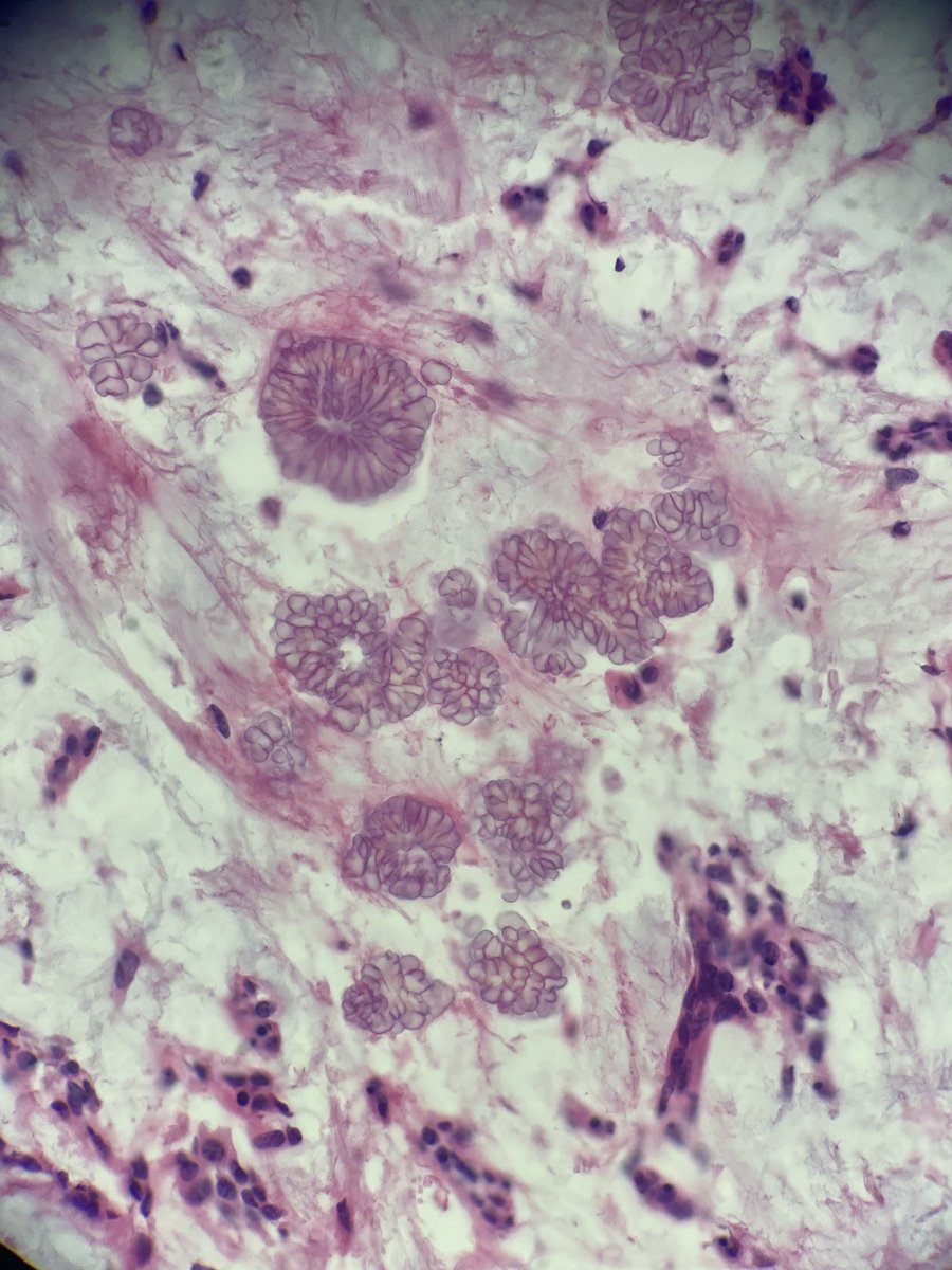 Floret-like tyrosine crystals in a pleomorphic adenoma. #pathology #PathTwitter #PathTweetAward #medicine