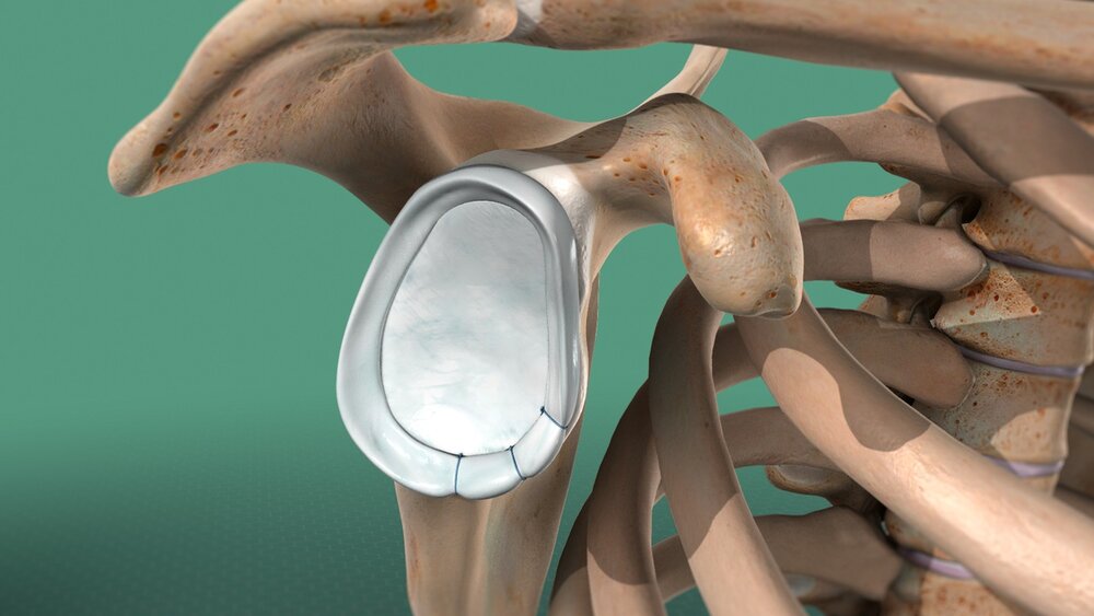SihamFayyad's tweet photo. https://t.co/EO5mL1YCXH
#خلع_الكتف
#shoulder_dislocation
#الجزء_الثاني https://t.co/k3NOouqv0d