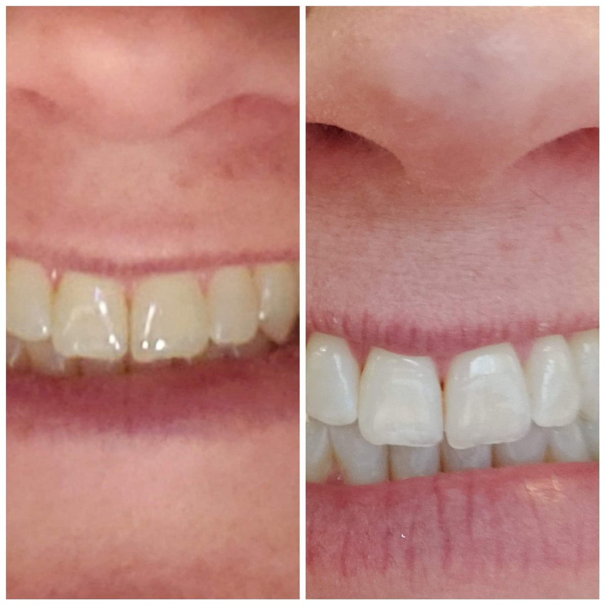 April96529948's tweet photo. Tired of having yellow dingy teeth?  How about brighten that smile!  I can help you with that!  #pearlywhites https://t.co/eaUYBGX0QS
