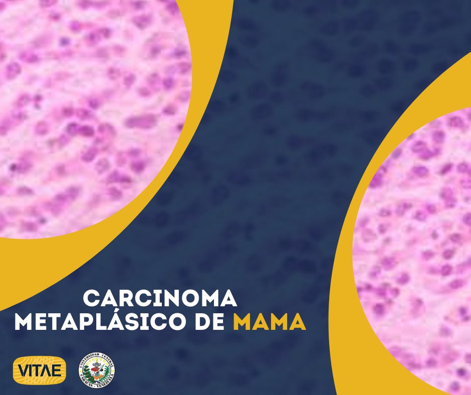 VitaeUCV's tweet photo. Son pocos los casos reportados de carcinoma metaplásico de mama, una neoplasia muy rara que presenta dificultades diagnósticas y terapéuticas, y por ello se plantean serios obstáculos para abordar esta patología. 
Más información: https://t.co/jOR8c6VXPu https://t.co/ctRSTVl6Kx