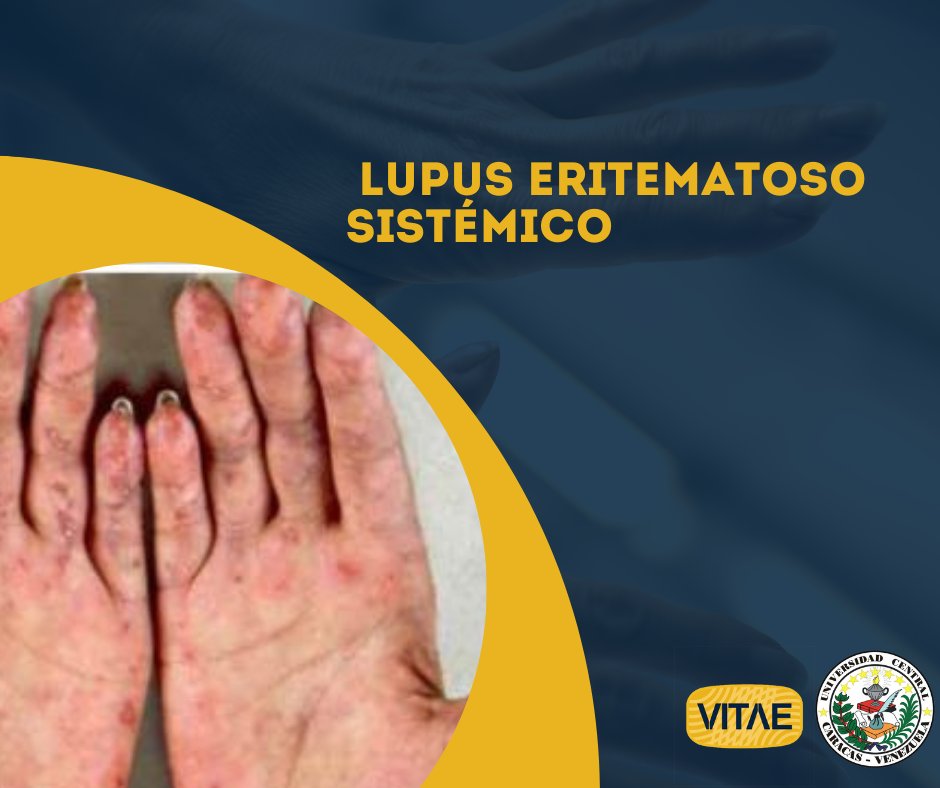 VitaeUCV's tweet photo. El lupus eritematoso sistémico es una enfermedad autoinmune que afecta a todos los órganos. Es más frecuente en mujeres, sin embargo, los hombres desarrollan enfermedades sistémicas con una alta tasa de morbimortalidad. https://t.co/jX8txr3Rtw https://t.co/fipTI83JCZ