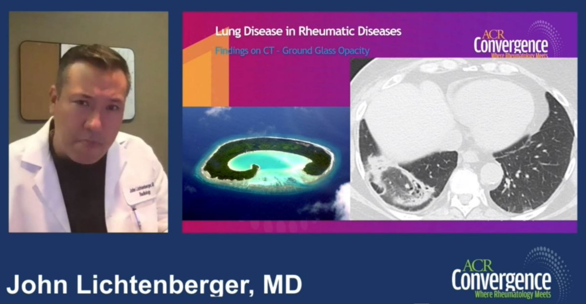 catysanchez00's tweet photo. Happening right now at #ACR21! Radiology Boot Camp. Remarkable teaching by Dr. Linchtenberger on lung manifestations in rheumatic diseases: Atoll Sign. I also want to go to the Maldives! @ACRheum https://t.co/Gxs0hoNhMB