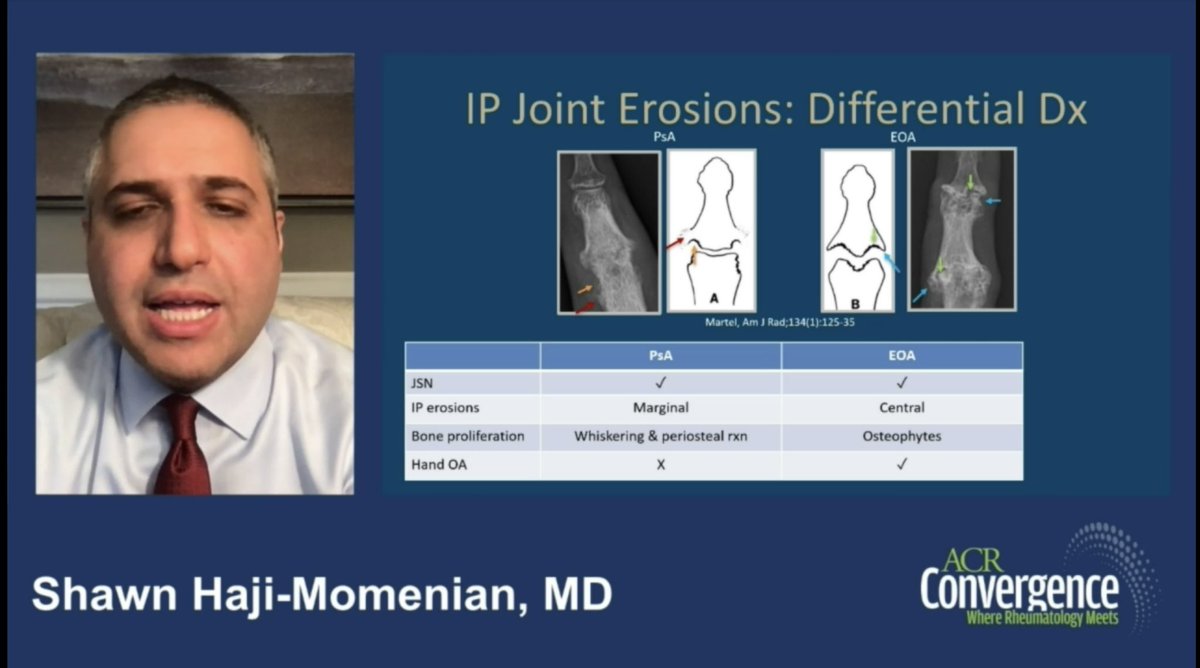 Targeting the HUGE dilemma!🎯

#Psoriatic vs Erosive #OA 

PsA
👉 Fluffy bone formation(enthesitis of phalanges) 
👉 Marginal erosions(vs central)
👉 Many jts in same digit(ray inv)
👉 Periarticular SOFT tissue swelling (dactylitis).
👉 NOT much hand OA

#ACR21 RadiologyBootCamp