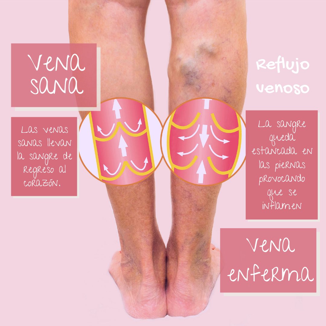 angioycvascgdl's tweet photo. ¿Ya sabes que es la enfermedad venosa?🦵🏼
Te mostramos la diferencia entre una vena sana y una enferma
✅ Cuida tu circulación #hazloenmanosdeexpertos
#angiomedikal #angiotips #angiologo #angiologia #zapopan #guadalajara #varices #escleroterapia #insuficienciavenosa https://t.co/984fNRRHER
