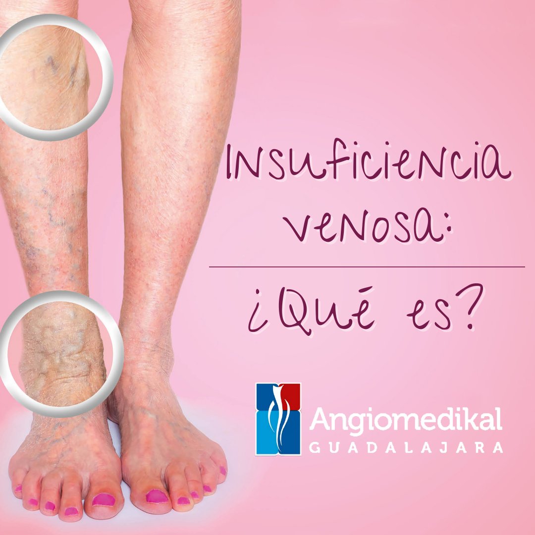angioycvascgdl's tweet photo. ¿Ya sabes que es la enfermedad venosa?🦵🏼
Te mostramos la diferencia entre una vena sana y una enferma
✅ Cuida tu circulación #hazloenmanosdeexpertos
#angiomedikal #angiotips #angiologo #angiologia #zapopan #guadalajara #varices #escleroterapia #insuficienciavenosa https://t.co/984fNRRHER