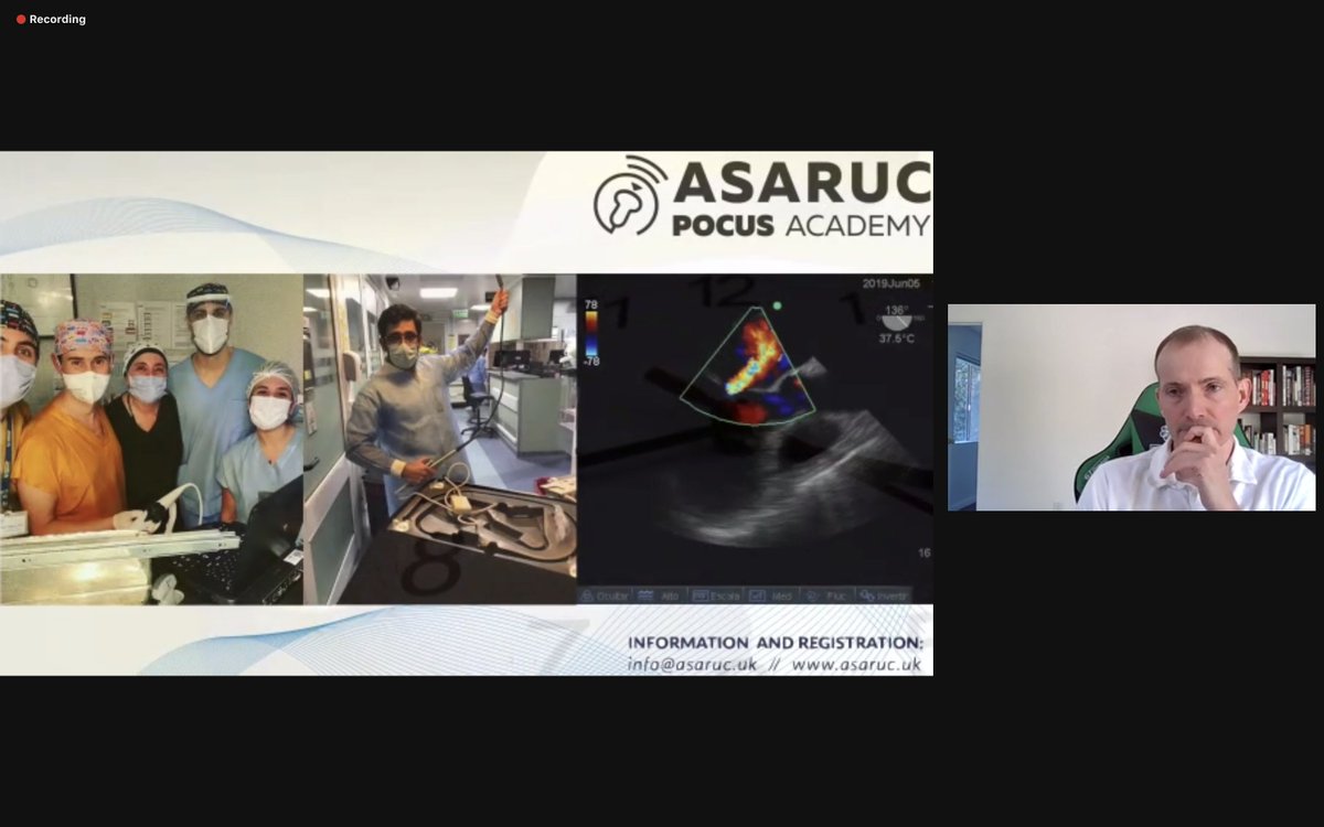 ASARUC1's tweet photo. Great Lecture of VExUS Principles in CARDIOPULMONARY POCUS COURSE
Korbin Haycock 🇺🇸
Francisco Curro Miralles Aguiar 🇪🇸
Practical Video by Matias Brizuela 🇦🇷
⚡️ASARUC POCUS ACADEMY https://t.co/8GVUIUnF3t
#POCUSACADEMY
#POCUS https://t.co/ymJDi6jvty