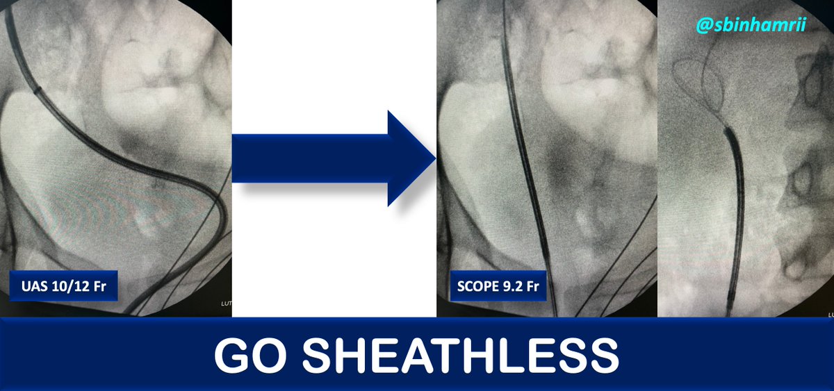 sbinhamrii's tweet photo. ���️KINKING FORCE IS NOT IMPORTANT AS YOUR FEELING OF #URETER RESISTANCE
⚪️IF THE URETER DOES NOT ACCEPT YOUR SMALLEST UAS 👉DON'T FORCE 👉GO #SHEATHLESS
👂REDUCING 2.8 FR = 0.84 MM ➡️ MADE THE DIFFERENCE
@PETRAurogroup https://t.co/o9bZWNkB3B