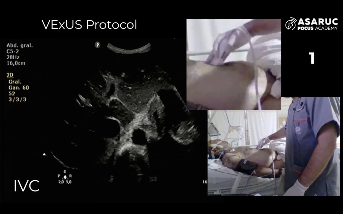 ASARUC1's tweet photo. Great Friday of VExUS Principles in CARDIOPULMONARY POCUS COURSE
Korbin Haycock 🇺🇸
Francisco Curro Miralles Aguiar 🇪🇸
Practical Video by Matias Brizuela 🇦🇷
⚡️ASARUC POCUS ACADEMY https://t.co/2bN2iZcjQL
#POCUSACADEMY
#POCUS https://t.co/RJNNpzDTw4