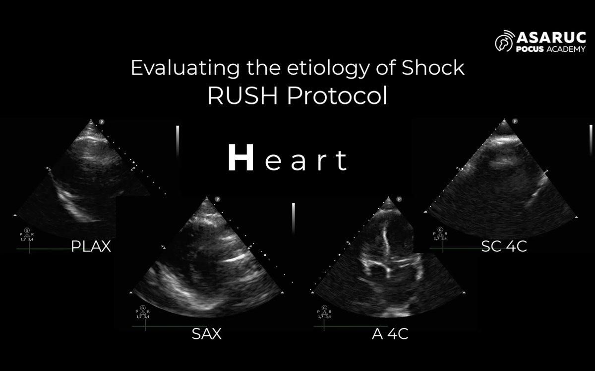ASARUC1's tweet photo. Great Friday of VExUS Principles in CARDIOPULMONARY POCUS COURSE
Korbin Haycock 🇺🇸
Francisco Curro Miralles Aguiar 🇪🇸
Practical Video by Matias Brizuela 🇦🇷
⚡️ASARUC POCUS ACADEMY https://t.co/2bN2iZcjQL
#POCUSACADEMY
#POCUS https://t.co/RJNNpzDTw4
