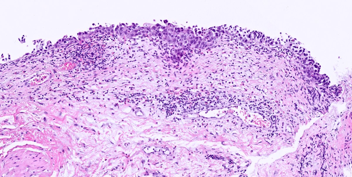 kis_lorand's tweet photo. 1/ What is you favorite IHC for urothelial carcinoma in situ/CIS? 😀
#pathology #gupath https://t.co/8LqCprGCsz