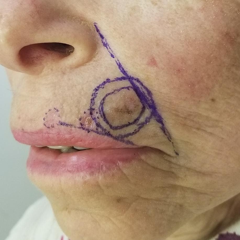 MohsCollege's tweet photo. #FlapFriday- This patient underwent Mohs surgery for a Melanoma in situ on the upper lip. The defect was repaired with a V-to-Y advancement flap. Follow up is shown at two months.
Photo Credit: Vitaly Terushkin, MD, FACMS - @drvitalyt https://t.co/zFIHTT05sH