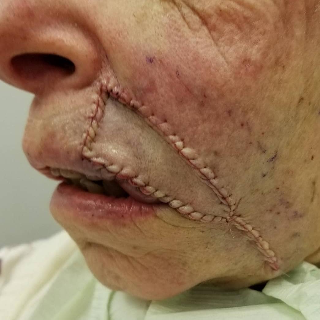 MohsCollege's tweet photo. #FlapFriday- This patient underwent Mohs surgery for a Melanoma in situ on the upper lip. The defect was repaired with a V-to-Y advancement flap. Follow up is shown at two months.
Photo Credit: Vitaly Terushkin, MD, FACMS - @drvitalyt https://t.co/zFIHTT05sH