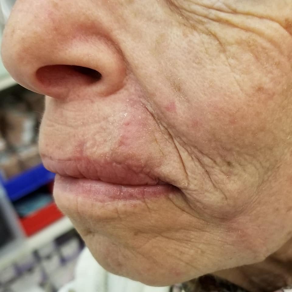 MohsCollege's tweet photo. #FlapFriday- This patient underwent Mohs surgery for a Melanoma in situ on the upper lip. The defect was repaired with a V-to-Y advancement flap. Follow up is shown at two months.
Photo Credit: Vitaly Terushkin, MD, FACMS - @drvitalyt https://t.co/zFIHTT05sH