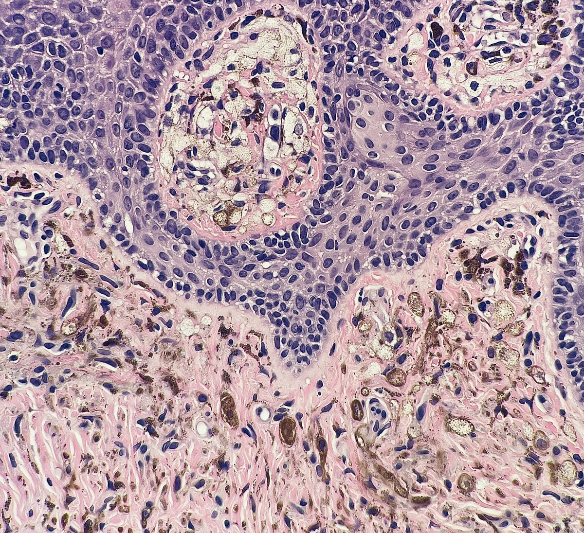 elimoreymd's tweet photo. Blue nevus with balloon 🎈cell change! No increased risk of malignancy. Interesting how two adjacent areas show differing levels of melanin content. Blue nevi are most common in peds/young adults. Often head and neck, hands or feet. #dermpath #pathtwitter #dermtwitter #pediatrics https://t.co/Fpf4F70jcP