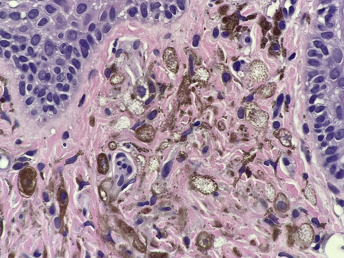 elimoreymd's tweet photo. Blue nevus with balloon 🎈cell change! No increased risk of malignancy. Interesting how two adjacent areas show differing levels of melanin content. Blue nevi are most common in peds/young adults. Often head and neck, hands or feet. #dermpath #pathtwitter #dermtwitter #pediatrics https://t.co/Fpf4F70jcP