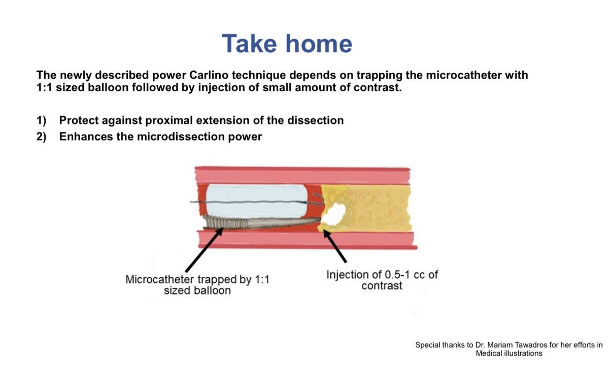 MichaelMegalyMD's tweet photo. “Power Carlino” a modification of the Carlino for wire impenetrable caps. Presented today @TCTConference @TCTMD #TCT2021 and published simultaneously at @JACCJournals #cardiotwitter #Pcicase  https://t.co/tO8hUjbnxJ ⁦@KAlaswadMD⁩ ⁦@Babar_Basir⁩ ⁦@esbrilakis⁩ https://t.co/Yrm6dJDOcI