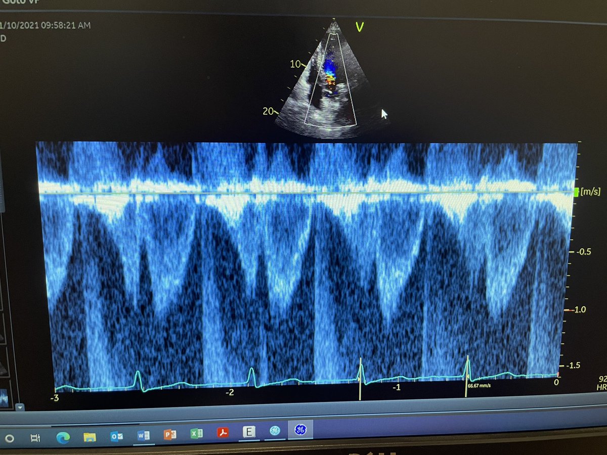 Jordan Strom, MD, MSc, FACC, FASE (@docstrom) on Twitter photo #EchoFirst Friday case: what is the name of the forward late diastolic velocity envelope seen in late diastole in this PW of the LVOT and what causes it? <a href="/ASE360/">American Society of Echocardiography</a> <a href="/VLSorrellImages/">V.L.Sorrell, MD (<a href="/CASEfromASE/">CV Case Journal</a> EIC)</a> <a href="/onco_cardiology/">Juan Lopez-Mattei, MD</a> @CASEfromASE <a href="/purviparwani/">Dr. Purvi Parwani</a> <a href="/iamritu/">Ritu Thamman MD</a> <a href="/the_gelf/">Eli Gelfand, MD, FACC</a> <a href="/HeartOTXHeartMD/">John P Erwin III MD MBA MACC (#BigPoppy )</a> #EchoFirst Friday case: what is the name of the forward late diastolic velocity envelope seen in late diastole in this PW of the LVOT and what causes it? <a href="/ASE360/">American Society of Echocardiography</a> <a href="/VLSorrellImages/">V.L.Sorrell, MD (<a href="/CASEfromASE/">CV Case Journal</a> EIC)</a> <a href="/onco_cardiology/">Juan Lopez-Mattei, MD</a> @CASEfromASE <a href="/purviparwani/">Dr. Purvi Parwani</a> <a href="/iamritu/">Ritu Thamman MD</a> <a href="/the_gelf/">Eli Gelfand, MD, FACC</a> <a href="/HeartOTXHeartMD/">John P Erwin III MD MBA MACC (#BigPoppy )</a>