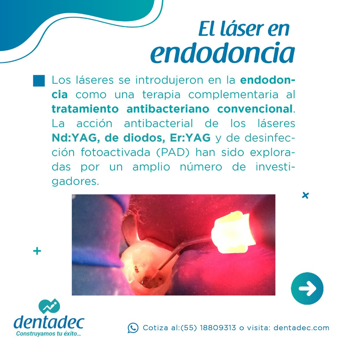 dentadecmexico's tweet photo. Feliz día del #endodoncista 🦷
¿Sabes cuál es el láser adecuado para tener éxito en dientes con periodontitis apical?
#endodoncia #endo #dentista #dentistry #dental #odontolove #laserdental #odontologia https://t.co/TXWdEnmptq