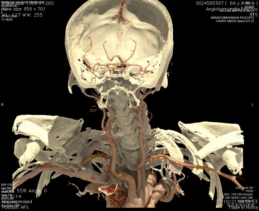 lbncbma's tweet photo. #endovascularsurgery #PTA #criticallimbIschemia #thinkaorta  #medtwitter
#aneurysm #practicemakesperfect #vasculartraining #hybridroom #teamvascular #revascularization #amputationprevention  #surgicalbypass #varizes #peripheralarterialdisease #PADdiagnosis https://t.co/hmtP52x564