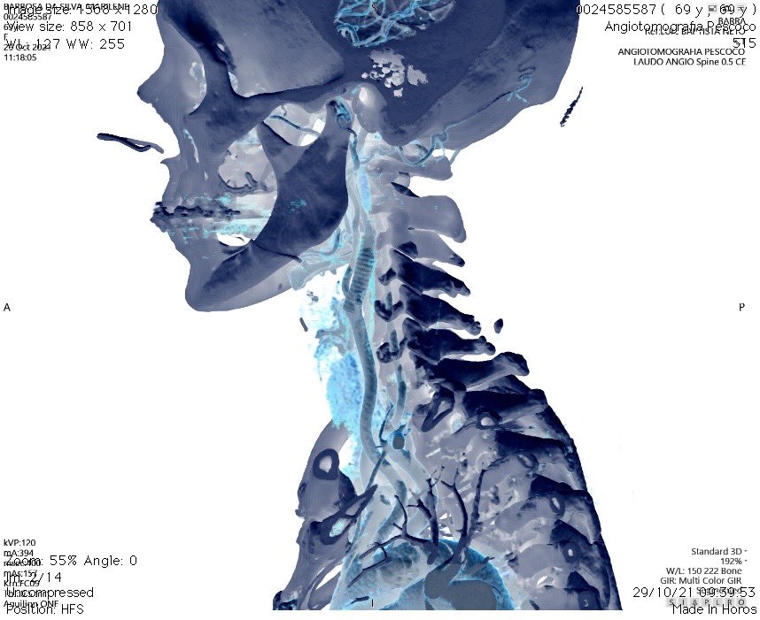 lbncbma's tweet photo. #endovascularsurgery #PTA #criticallimbIschemia #thinkaorta  #medtwitter
#aneurysm #practicemakesperfect #vasculartraining #hybridroom #teamvascular #revascularization #amputationprevention  #surgicalbypass #varizes #peripheralarterialdisease #PADdiagnosis https://t.co/hmtP52x564